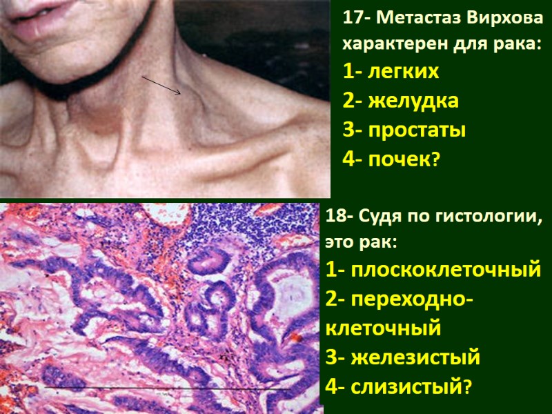 17- Метастаз Вирхова характерен для рака: 1- легких 2- желудка 3- простаты 4- почек?